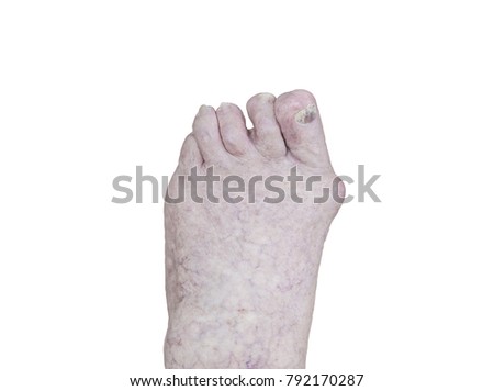 isolated senior person's foot with arthritis, damaged nails. isolated on white