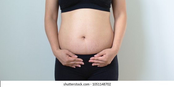 Isolated Woman Front Body After Gave Birth, Strech Mark, Fat Belly 