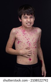 Itching, Scabies, 8 Year Old Boy .  Chickenpox Virus.Skin Rash In A Child