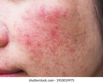 Itchy And Allergic Skin Problems, Dermatitis On Young Asian Thai Woman Face.