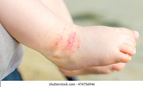 itchy dermatitis atopic baby foot - Shutterstock ID 474756946