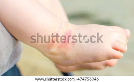 itchy dermatitis atopic baby foot