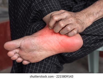 Itchy Foot Skin Of Asian Elder Man. Concept Of Skin Diseases Such As Scabies, Fungal Infection, Eczema, Psoriasis, Rash, Allergy, Etc.