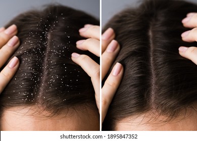 Itchy Head Scalp And Dandruff Problem Before And After