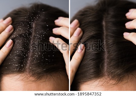 Itchy Head Scalp And Dandruff Problem Before And After Foto stock © 