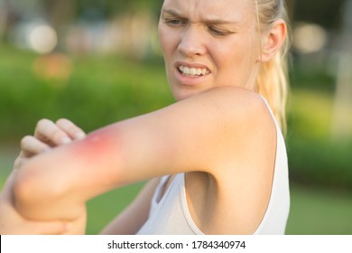 Itchy insect bite - Irritated young female scratching her itching arm from a mosquito bite at the park during summertime. - Shutterstock ID 1784340974