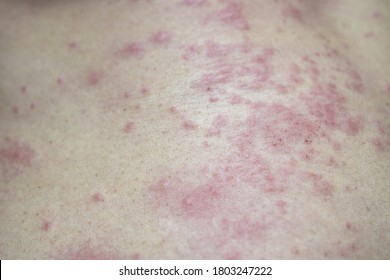 1803247222. Itchy rash, Skin rash on body, Itchy red rash on the abdomen of...