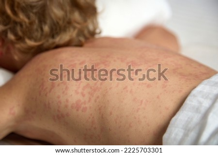 Itchy red spots strewn the entire back of a sick child. A small child lies in bed on his stomach, more rubella