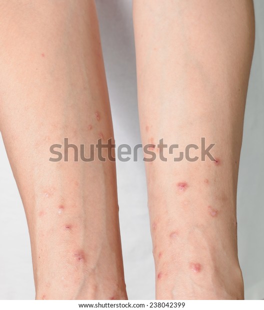 Itchy Skin Lesions Allergies Skin Women Stock Photo 238042399 ...