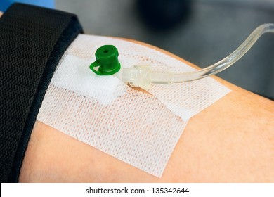 IV Drip With Cannula (catheter) In Arm