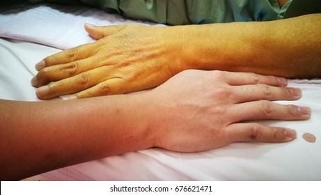 Jaundice Patient With Yellowish Discoloration Of Skin In Comparison With Normal Skin Color.