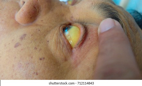 Jaundice: Yellowish Discoloration Of Sclera, A Sign Of Liver Failure.