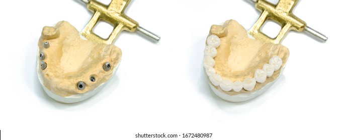 Jaw Models With Dental Implants And Orthopedic Implant Construction. Implant Prosthetics Concept. Orthopedic Dentistry. Isolated On A White Background. Before And After Prosthetics With Ceramic Crowns