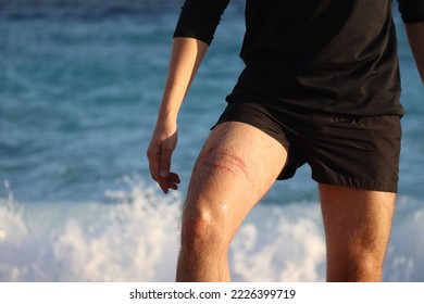 A jellyfish sting burn on a man's leg, on the beach - Shutterstock ID 2226399719