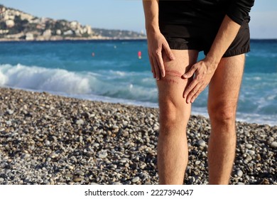 A jellyfish sting burn on a man's leg, on the beach - Shutterstock ID 2227394047