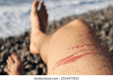 A jellyfish sting burn on a man's leg, on the beach - Shutterstock ID 2314477031