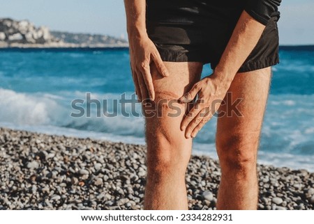 A jellyfish sting burn on a man's leg, on the beach