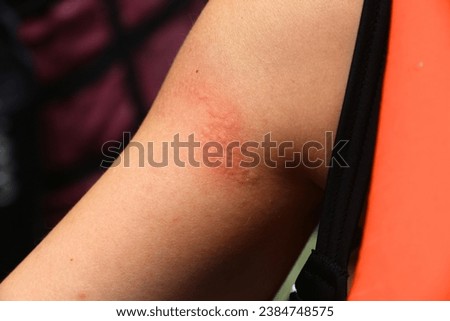 Jellyfish sting mark on woman tourist's arm in Palawan island, Philippines.