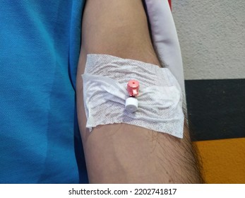 Kartal, Istanbul, Turkey - 07.24.2021: Close Up View Of Vascular Access Device (VAD) On Left Arm Of A Man With Casual Clothes In Front Of Wall With Copy Space