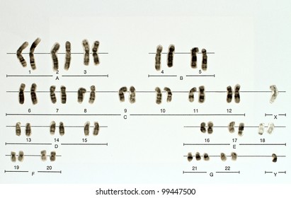 Karyotyp Of Human Male With Trisomy 21 / Down Syndrome