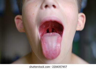 Kazan, Russia, 07.2022, A Child With Scarlet Fever Shows His Throat