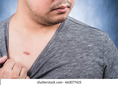 Keloid On A Man's Chest