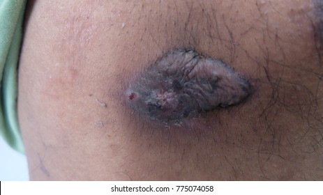 Keloid At The Post Chest Tube Side.