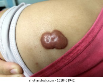 Keloid Scar From Genetics