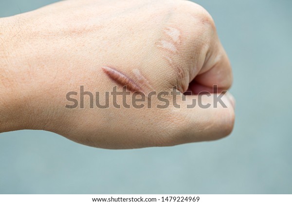 Keloid scar (Hypertrophic Scar) on man hand skin\
after accident. keloidal scar on wrist skin cause by surgery in car\
accidental , is a formation of a type of scar at the site of a\
healed skin injury.