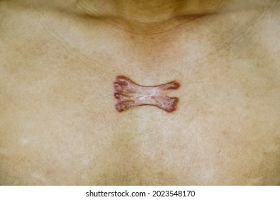 Keloid Scar On The Chest Of An Asian Man. Inflamed And Raised Scars Form On The Skin Caused By A Single Pimple