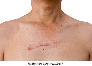 Keloid Scar On The Skin Chest.