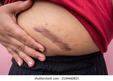 Keloid Scars On Stomach After Appendectomy Stock Photo Edit Now