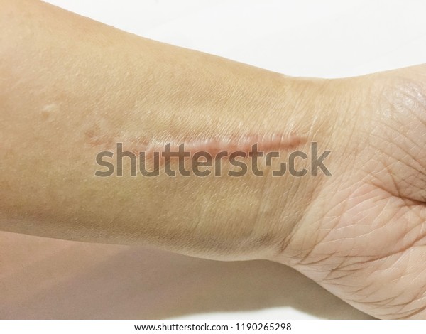 keloidal scar on wrist skin cause by surgery\
in car accidental , is a formation of a type of scar at the site of\
a healed skin injury. Hypertropic scar on surgical incision sites\
with white background
