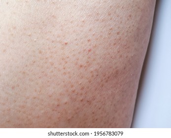 Keratosis Pilaris or Chicken skin on woman inner leg