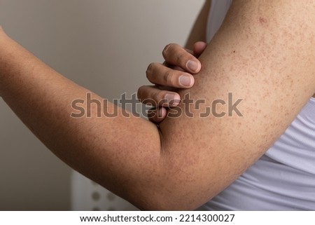 Keratosis Pilaris a harmless skin condition that causes dry, rough patches and tiny bumps, often on the upper arms