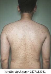 Keratosis Pilaris On Back