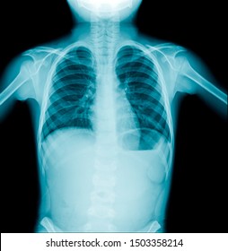 kid chest x-ray image in blue tone
