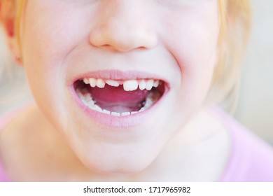 Kid With Crooked Teeth. Girl Show Her Diastema Teeth.