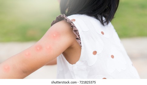 Kid Girl Has Allergies With Mosquitoes Bite And Itching Her Arm.Mosquito Blood Breeding On Kids.Repellent, Dengue Virus, Yellow Fever, West Nile, Malaria, Diseases Spread By Mosquitoes.monkeypox Virus