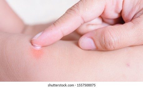 赤ちゃん 虫刺され の写真素材 画像 写真 Shutterstock