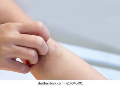 Kid Scratching Itchy Arm