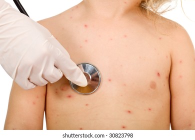 Kid Torso With Small Pox Consulted By A Physician - Isolated, Closeup