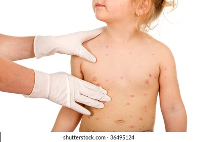 Kid Torso With Small Pox Consulted By A Physician - Isolated, Closeup