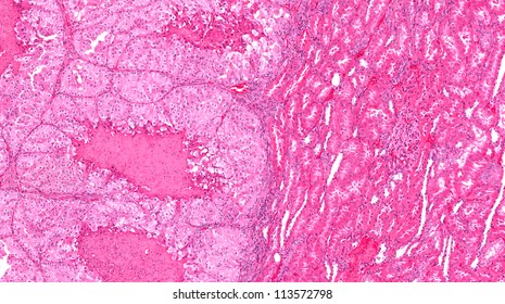 Kidney Cancer (left) And Normal Kidney (right). Renal Cell Carcinoma Has Replaced Normal Kidney Tissue And The Cancer Has Many Areas Of Tissue Death (necrosis).