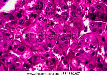 Kidney cancer, light micrograph, photo under microscope. High magnification