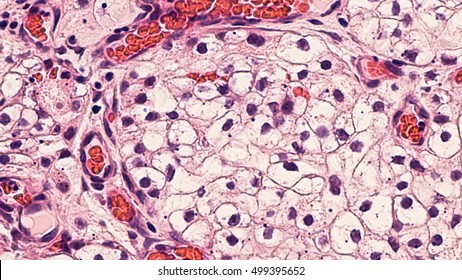 Kidney Cancer: Microscopic Image Of Clear Cell Carcinoma, The Most Common Type Of Renal Cell Carcinoma.  It Is  Characterized By Cytoplasmic Clearing And A Pattern Of Small Branching Blood Vessels.  