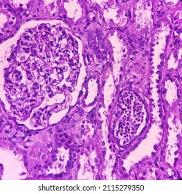 Kidney Cancer: Show Malignant Neoplasm, Clear Cell Carcinoma, Fuhrman Nuclear Grade-I, Renal Cell Carcinoma In Between Renal Tubules, Microscopic 40x View