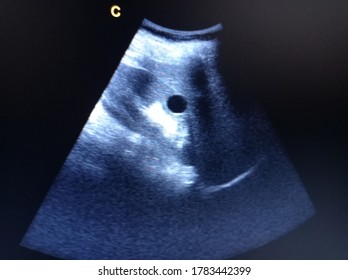 Kidney Cyst By Ultrasound Scan