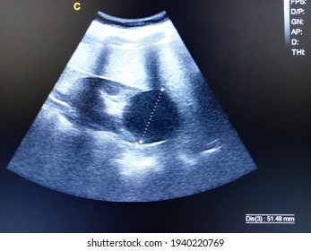 Kidney Cyst By Ultrasound Scan 