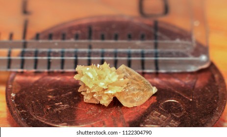 Kidney Stone With Ruler Meter